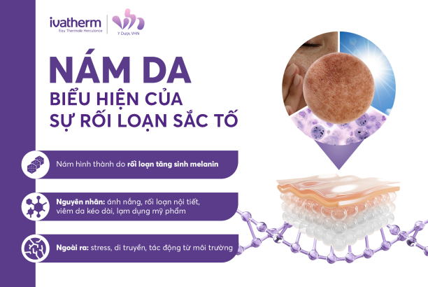 Ngang Nám da - Biểu hiện của sự rối loạn sắc tố